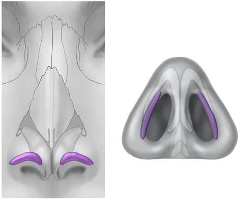 Integrated Alar-Lateral Crural Strut Graft: A Novel Technique for ...