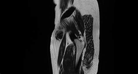 Pixel Myositis Ossificans Heterotopic Ossification