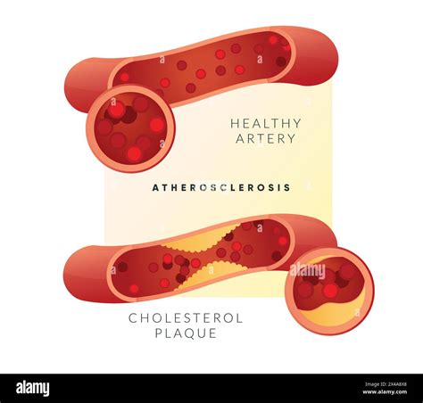 Atherosclerosis Plaque Buildup Stock Illustration As Eps File