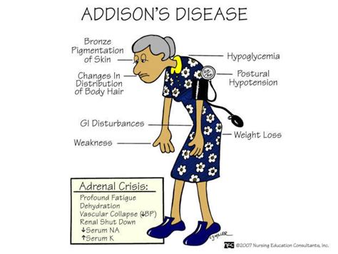 Addison Disease Symptoms Causes And Homeopathic Treatment