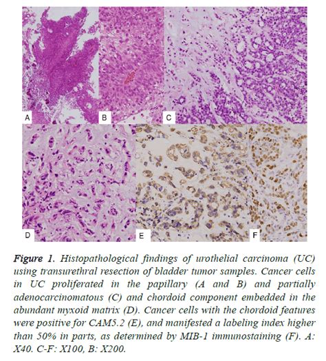 Immunohistochemical Analyses In A Case Of High Grade Urothelial