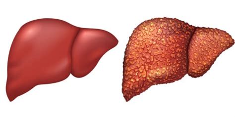 ultrasound test of liver shows coarse echotexture with dilated portal vein chronic liver disease ...