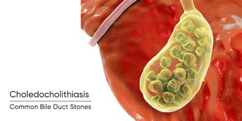 What Are Common Bile Duct Stones Choledocholithiasis Chennai Laser Gastro