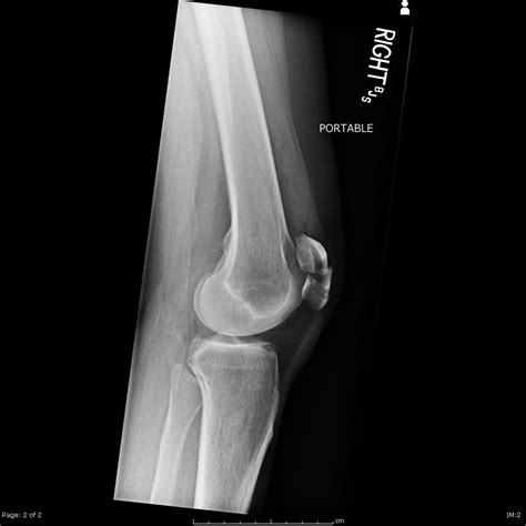 Patella Fracture X Ray