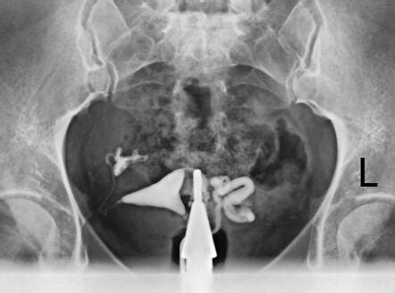 Unilateral Tubal Block And Hydrosalpinx Radiology Case Radiopaedia Org