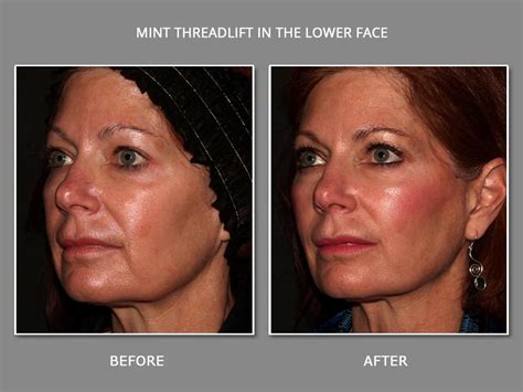 Non Surgical Facelift In Broomfield CO MINT Thread Lift