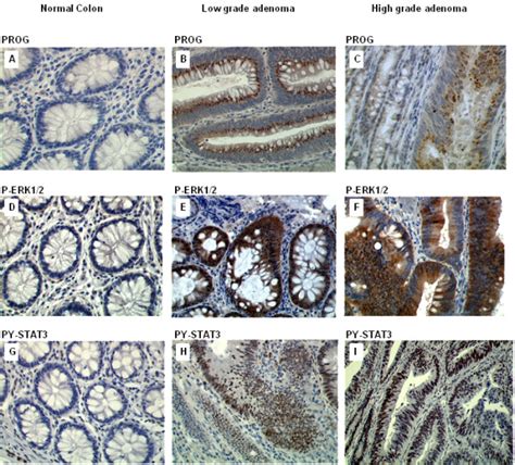 Expression Of Progastrin P ERK1 2 And PY STAT3 In Normal Colonic Mucosa