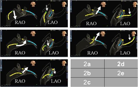 Zero Fluoroscopy Approach For Ablation Of Supraventricular Tachycardia