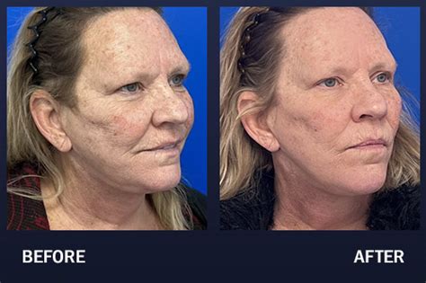 Co Laser Skin Resurfacing Before After Photo Gallery Nashville Tn