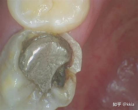 根管治疗后的牙齿崩了怎么办？补牙？牙冠？嵌体？（持续更新） 知乎