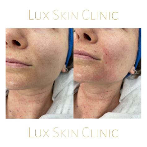 Mezoterapia Igłowa Atrakcyjne ceny Luxskin Clinic