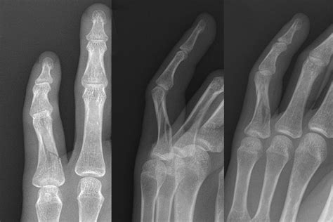 Finger Proximal Phalanx Fracture Adult Hand Surgery Resource