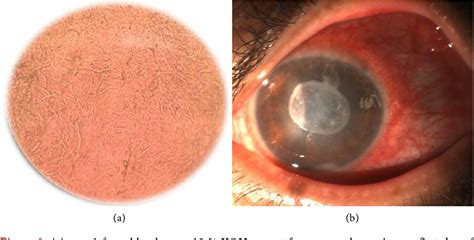 Figure 1 From Polymicrobial Keratitis—importance Of Detecting And Treating More Than One