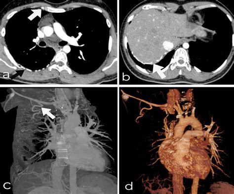 Year Old Male With Right Sided Proximal Interruption Of Pulmonary