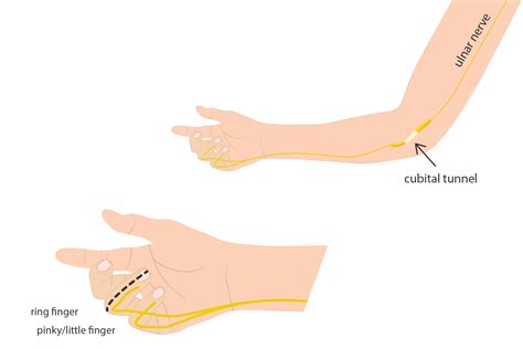 Buzzy English Sindrome Del Tunnel Cubitale E Sindrome Del Canale Di Guyon
