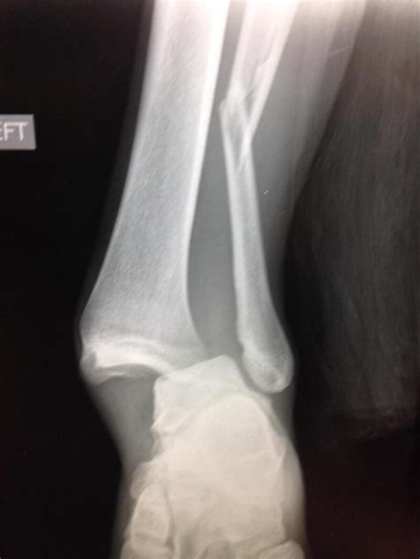 [Figure, Ankle Fracture Weber C Ankle fracture with dislocation ...