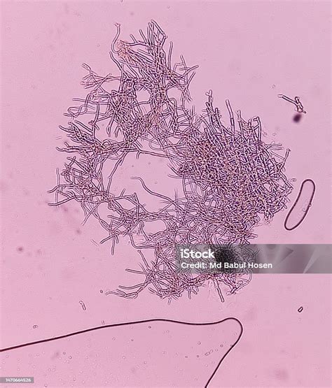 Microscopic Fungi Malassezia Furfur Showing Yeast Cells And Hyphae