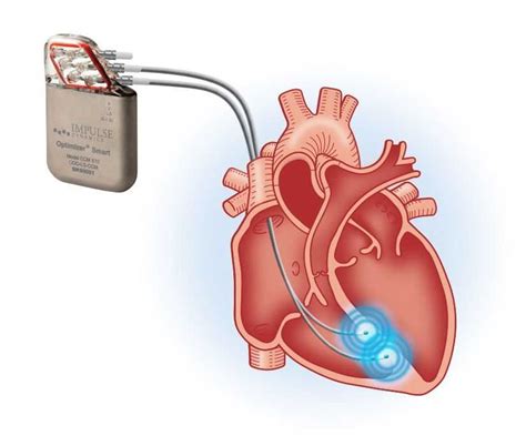 Unc Medical Center First In The Carolinas To Treat Heart Failure