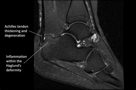 Achilles Tendonitis — Daniel Bohl Md Midwest Orthopaedics At Rush