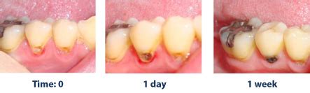 Silver Diamine Fluoride for Cavity Control | Playtime Dentistry