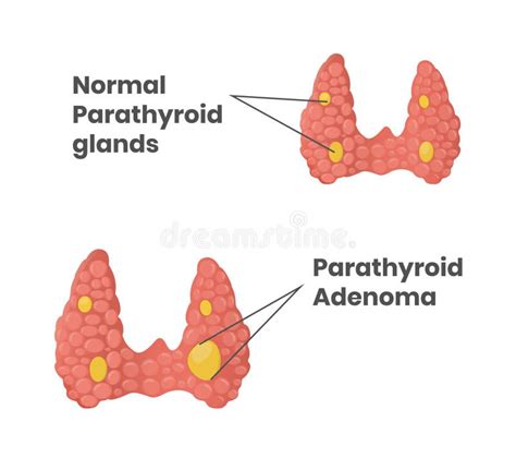 Illustration De Vecteur De Glande Thyroïde Illustration De Vecteur