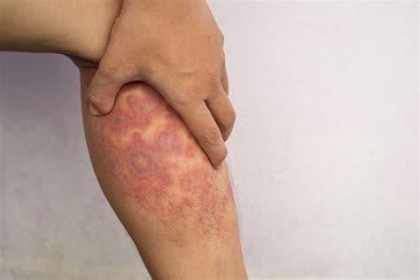 How To Treat Eczema On Elbows