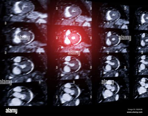 Mri Heart Or Cardiac Mri Magnetic Resonance Imaging Of Heart For