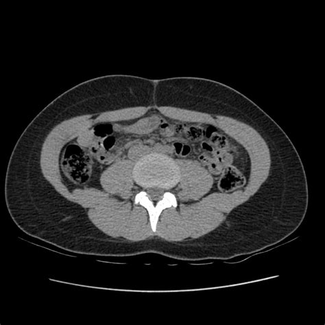 Normal CT abdomen and pelvis triphasic protocol Image