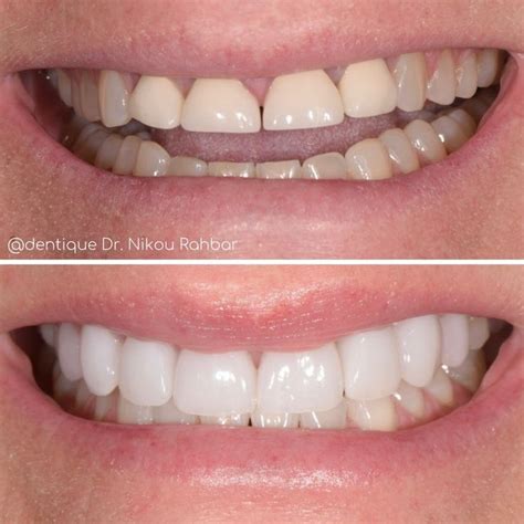 Veneer Transformation In 2024 Cosmetic Dentist Dentistry Whitening