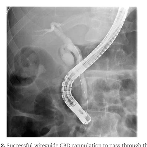 Figure 2 From Incidentally Portal Vein Penetration During Cannulation