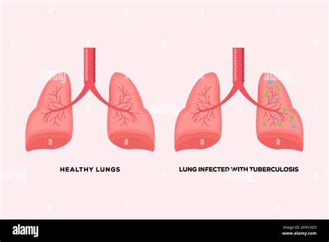 Healthy Lungs And Lungs Infected With Tuberculosis Stock Vector Image