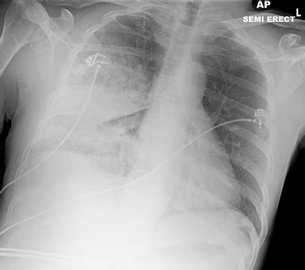 Right Upper Lobe Consolidation Radiology Case Radiopaedia Org