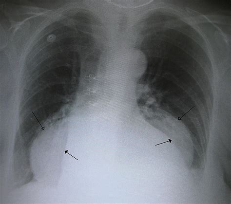 Hiatal hernia - Wikipedia