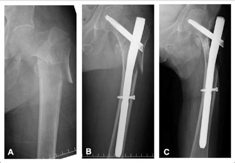 AO OTA 31A3 3 Fracture In An 83 Year Old Woman Height 147 Cm A And