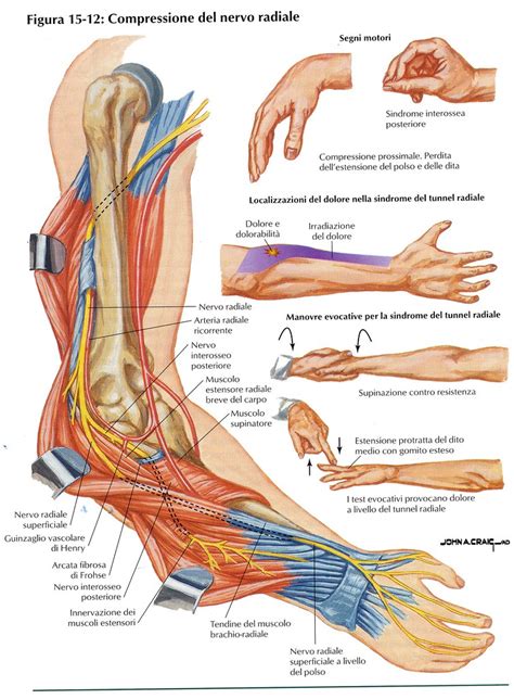 Gomito Compressione Nervo Radiale Lesione Nervo Radiale Flickr