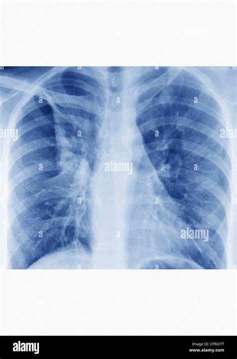 BRONCHITIS, X-RAY Stock Photo - Alamy