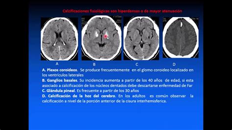 Tomografía Computarizada Del Cerebro