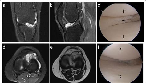 A And B Coronal And Sagittal Magnetic Resonance Image Mri Of Left