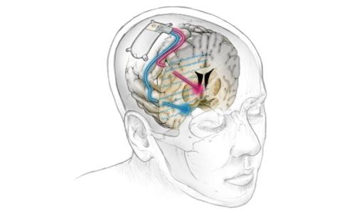 Realizaron El Primer Implante Exitoso De Un Marcapasos Cerebral Para