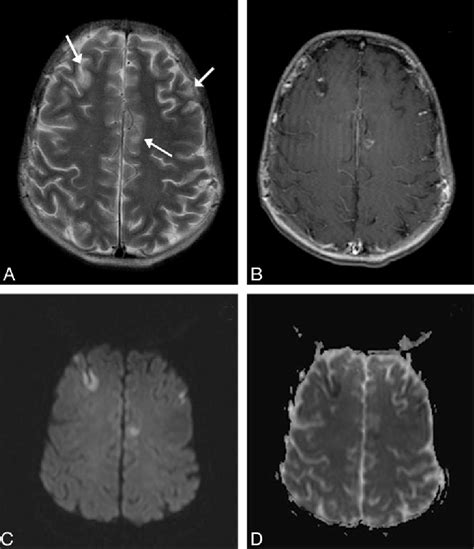 Figure 3 From SyndromeFindings In A Patient With Hemophagocytic