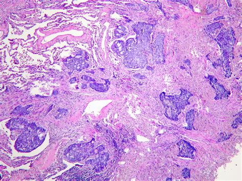 Basaloid Squamous Cell Carcinoma Case 275 Lobectomy Flickr