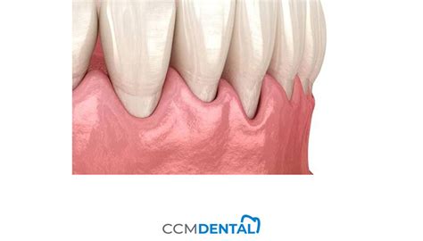 C Mo Prevenir La Periodontitis Ccm Dental