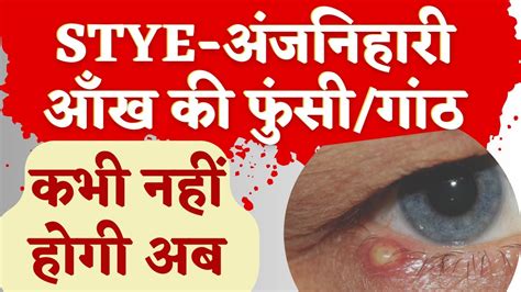 Eye Stye या आँख की अंजनियारी गुहेरी फुंसी का इलाज Anjaniyari