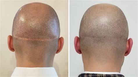 Hair Transplant Scar: Getting Rid Of & Repair Options - Bald & Beards