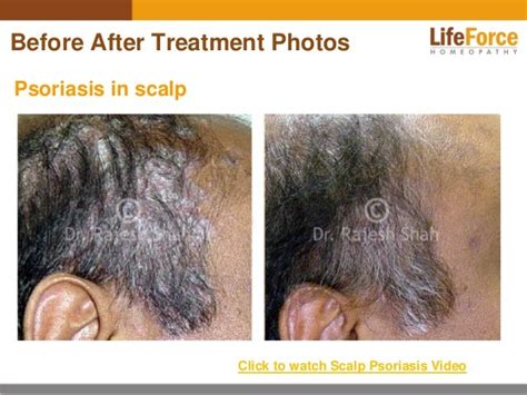 Psoriasis on Scalp & Head Photos: Before After Treatment Pictures