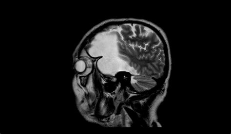 Arachnoid Cyst Mri Radiology Article On Arachnoid Cyst