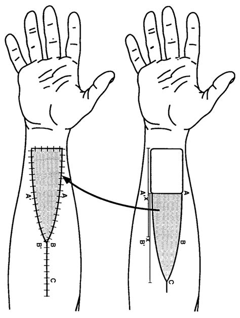 Schematic Drawing Of The Triangular Shaped Full Thickness Skin Graft