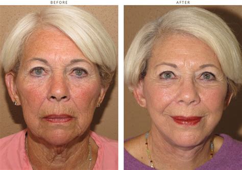 Mid Face Lift – Before and After Pictures * | Dr Turowski - Plastic ...