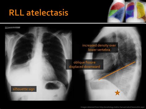 Ppt Atelectasis Powerpoint Presentation Free Download Id6757762