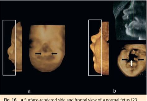 Figure From D Imaging Of The Fetal Face Recommendations From The